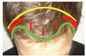 browlift-plastic-surgery-dr-barry-eppley-indianapolis.jpg