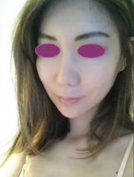 post op 1,5 month.png