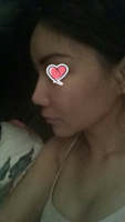 post op 3 months.png