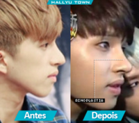 vixx ken nose