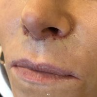 LIPS lip lift Miguel Mascaro, Delray Bch FL pop in to see him after DR or before.jpg