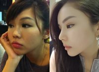 double eyelid surgery taiwan cost