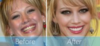hilary-duff-veneers-before-and-after-teeth.jpg