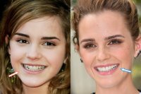 emma-watson-teeth.jpg
