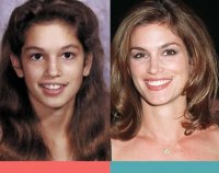 Adult-Braces-Cindy-Crawford-1-1024x810.jpg