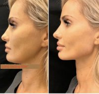 long lasting filler for jawline.jpg