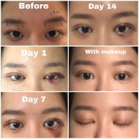 Eyelid surgery forum discount