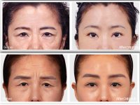 Seoul ASPS unbelievable browlift results.jpg