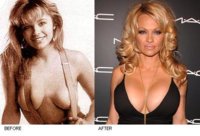 pamela-anderson-surgery1.JPG