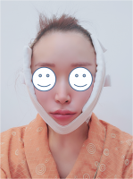 Facelift Surgery - After- on the surgery day.png