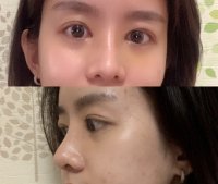 After surgery.jpg After surgery.jpg