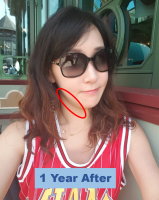 1 year after jaw surgery.png