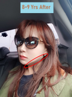 8~9 years after jaw surgery.png