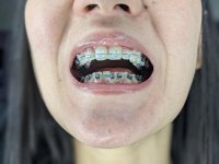 braces-day1-closeup.jpg