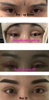 Brow lift Collage.jpg