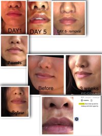 Liplift Dr Mascaro Korean girl.jpg