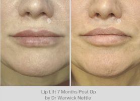 WARWICK NETTLE  liplift 7 months, she almost did NOT need it. Great job to keep her still look...jpg