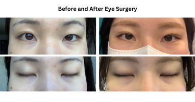 My Before after (eyes).JPG