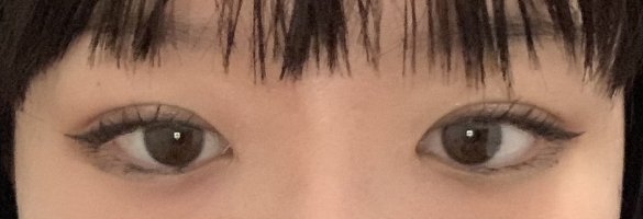 Double Eyelid Surgery Thank You PS PurseForum