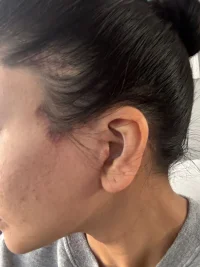 Left Scar.webp