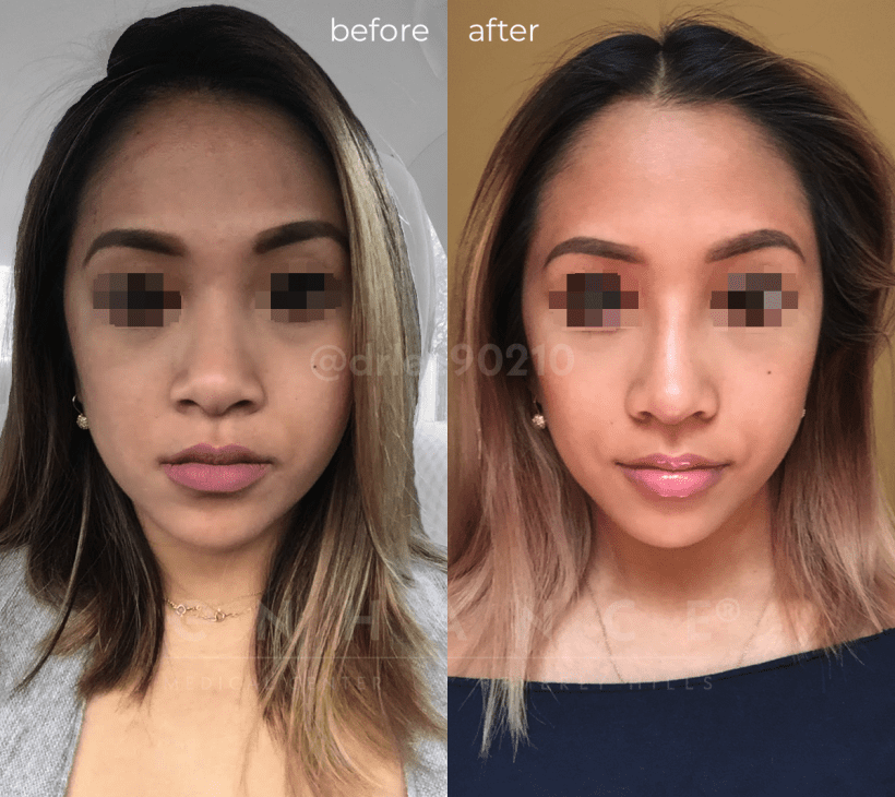 proxy.php?image=https%3A%2F%2Fwww.asiancosmeticsurgery.com%2Fwp content%2Fuploads%2F2018%2F10%2Frhinoplasty charles s lee beverly hills 7303 front acs
